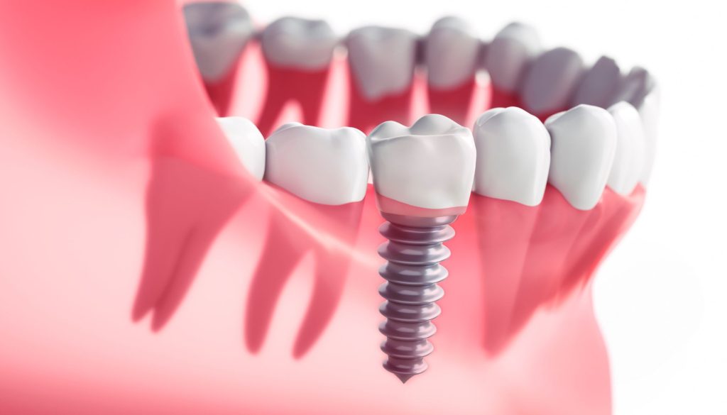 Dental Implant