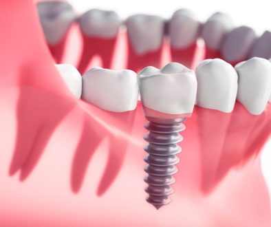 Dental Implant