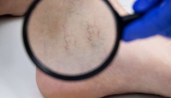 علاج-قدم-سكري-و-دوالي-الساقين