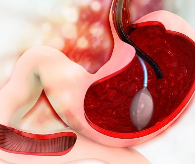 تركيب بالون المعدة للتخسيس