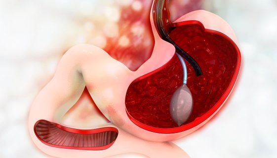 تركيب بالون المعدة للتخسيس