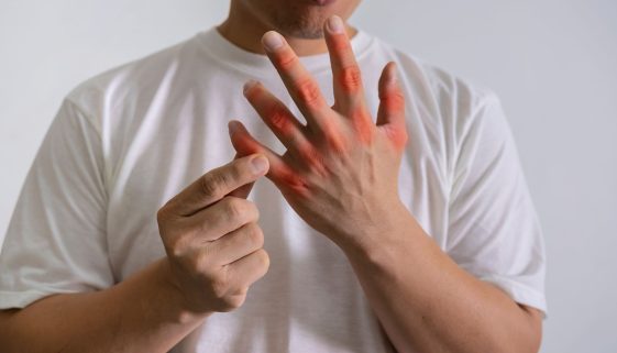 علاج النقرس