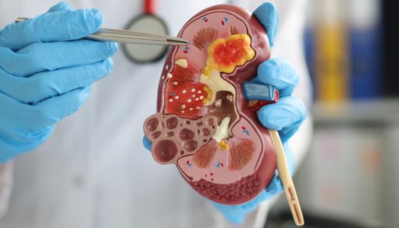 قصور وظائف الكلى