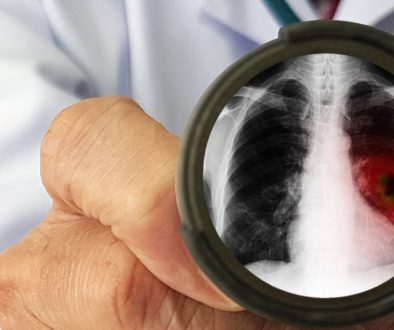 تشخيص واستئصال أورام الرئة