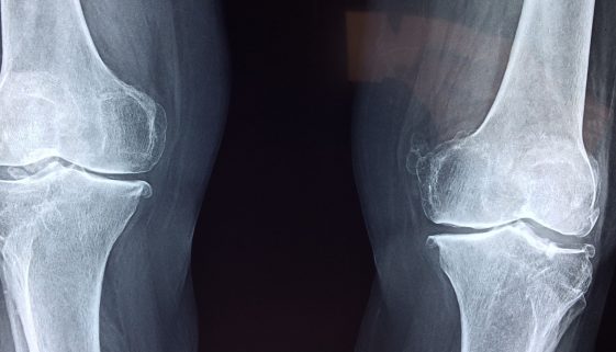 حفاظك على صحة عظامك