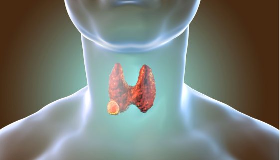 أورام الغده الدرقيه