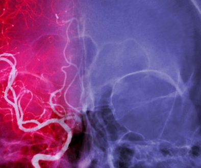 علاج حالات نزيف المخ