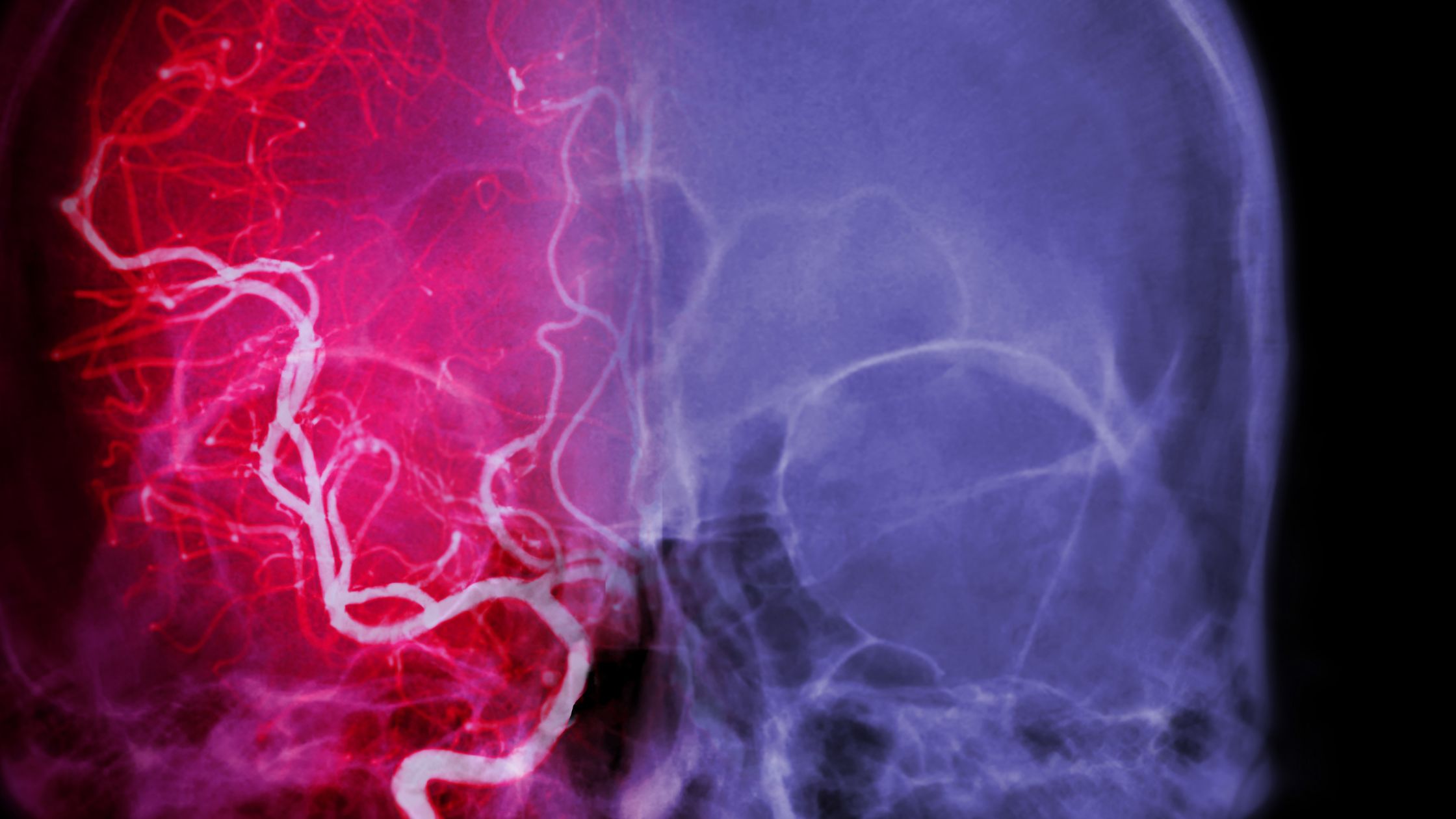 علاج حالات نزيف المخ