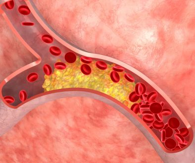 علاج إرتفاع نسبة الدهون بالدم والكوليسترول