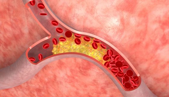 علاج إرتفاع نسبة الدهون بالدم والكوليسترول