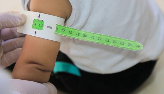 علاج سوء التغذية و متابعة نمو الطفل
