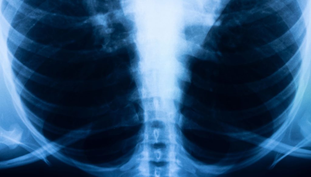 علاج التليف الرئوي والسده الرئويه