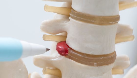 فهم الانزلاق الغضروفي وطرق علاجه بدون جراحة