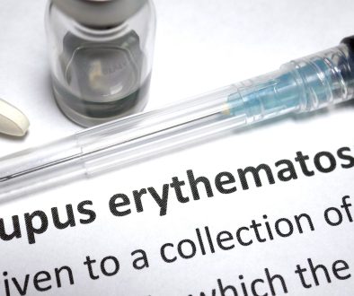 مرض الذئبة الحمراء