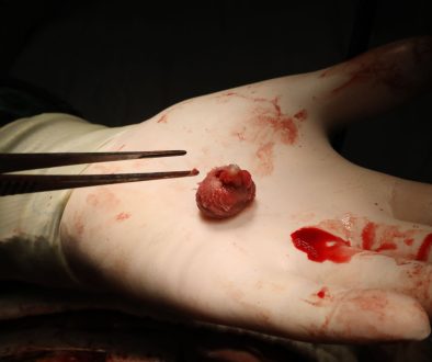 جراحات الأورام